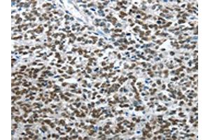 The image on the left is immunohistochemistry of paraffin-embedded Human ovarian cancer tissue using ABIN7128510(ARL2 Antibody) at dilution 1/15, on the right is treated with fusion protein.