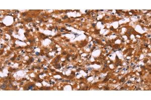 Immunohistochemistry of paraffin-embedded Human thyroid cancer using BRK1 Polyclonal Antibody at dilution of 1:40 (BRK1 anticorps)