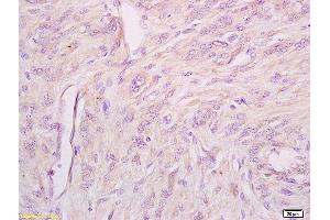 Formalin-fixed and paraffin embedded human cervical carcinoma tissue labeled with Anti phospho-IFNAR1(Ser535+Ser539) Polyclonal Antibody,Unconjugated (ABIN802353) at 1:200 followed by conjugation to the secondary antibody and DAB staining.