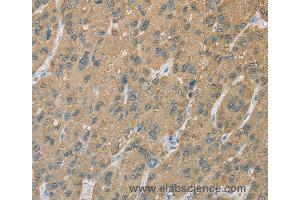 Immunohistochemistry of Human gastric cancer using CYP2C9 Polyclonal Antibody at dilution of 1:50 (CYP2C9 anticorps)