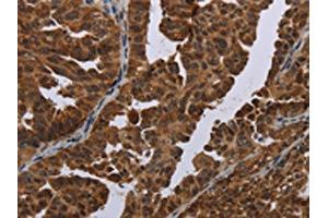 The image on the left is immunohistochemistry of paraffin-embedded Human ovarian cancer tissue using ABIN7191351(MAGEB3 Antibody) at dilution 1/20, on the right is treated with synthetic peptide. (MAGEB3 anticorps)