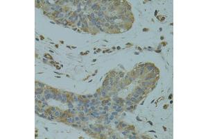 Immunohistochemistry of paraffin-embedded human breast cancer using DGKQ antibody (ABIN1872259) at dilution of 1:100 (40x lens). (DGKQ anticorps)