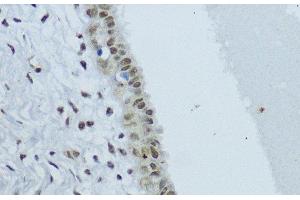 Immunohistochemistry of paraffin-embedded Human mammary cancer using NR1I3 Polyclonal Antibody at dilution of 1:200 (40x lens). (NR1I3 anticorps)