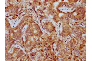 IHC image of ABIN7163100 diluted at 1:400 and staining in paraffin-embedded human liver cancer performed on a Leica BondTM system. (PHACTR1 anticorps  (AA 263-387))