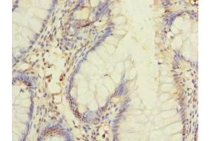 Immunohistochemistry of paraffin-embedded human colon cancer using ABIN7150013 at dilution of 1:100