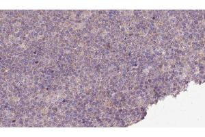 ABIN6273149 at 1/100 staining Human lymph cancer tissue by IHC-P. (PMPCB anticorps  (Internal Region))