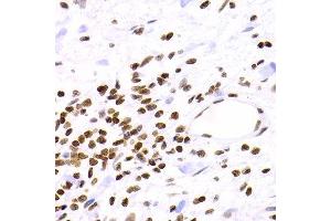 Immunohistochemistry of paraffin-embedded human gastric cancer using NFKB2 Antibody.