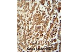 STC1 antibody (N-term) (ABIN654579 and ABIN2844281) immunohistochemistry analysis in formalin fixed and raffin embedded human testis carcinoma followed by peroxidase conjugation of the secondary antibody and DAB staining. (SPATC1 anticorps  (N-Term))