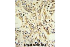 RPS13 Antibody (Center) (ABIN650998 and ABIN2840031) IHC analysis in formalin fixed and paraffin embedded breast carcinoma followed by peroxidase conjugation of the secondary antibody and DAB staining. (RPS13 anticorps  (AA 82-110))