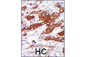 Formalin-fixed and paraffin-embedded human cancer tissue reacted with the primary antibody, which was peroxidase-conjugated to the secondary antibody, followed by DAB staining.
