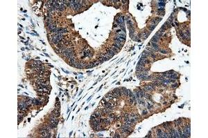 Immunohistochemical staining of paraffin-embedded Adenocarcinoma of colon tissue using anti-FAHD2Amouse monoclonal antibody. (FAHD2A anticorps)