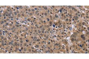 Immunohistochemistry of paraffin-embedded Human liver cancer tissue using KIF25 Polyclonal Antibody at dilution 1:40 (KIF25 anticorps)