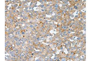The image on the left is immunohistochemistry of paraffin-embedded Human breast cancer tissue using ABIN7190004(BPIFB2 Antibody) at dilution 1/50, on the right is treated with synthetic peptide. (BPIL1 anticorps)