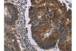 The image on the left is immunohistochemistry of paraffin-embedded Human colon cancer tissue using ABIN7129746(HSD17B6 Antibody) at dilution 1/20, on the right is treated with fusion protein. (HSD17B6 anticorps)