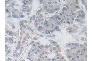 Detection of GPX3 in Human Pancreatic cancer Tissue using Polyclonal Antibody to Glutathione Peroxidase 3, Plasma (GPX3)