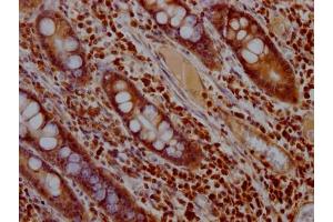 IHC image of ABIN7127477 diluted at 1:100 and staining in paraffin-embedded human colon cancer performed on a Leica BondTM system.