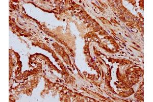 IHC image of ABIN7156973 diluted at 1:400 and staining in paraffin-embedded human prostate cancer performed on a Leica BondTM system. (IFT172 anticorps  (AA 1368-1502))