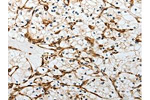 The image on the left is immunohistochemistry of paraffin-embedded Human renal cancer tissue using ABIN7193081(YBX1 Antibody) at dilution 1/15, on the right is treated with synthetic peptide. (YBX1 anticorps)