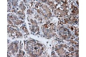 Immunohistochemical staining of paraffin-embedded Carcinoma of liver tissue using anti-LIPG mouse monoclonal antibody. (LIPG anticorps)