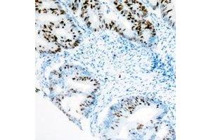 Immunohistochemistry (IHC) image for anti-SWI/SNF Related, Matrix Associated, Actin Dependent Regulator of Chromatin, Subfamily A, Member 4 (SMARCA4) antibody (ABIN7308346)