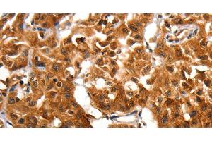 Immunohistochemistry of paraffin-embedded Human lung cancer using ADAP1 Polyclonal Antibody at dilution of 1:60