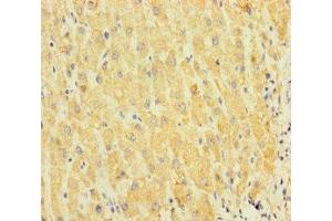 Immunohistochemistry of paraffin-embedded human liver cancer using ABIN7170610 at dilution of 1:100 (SPIN4 anticorps  (AA 1-249))