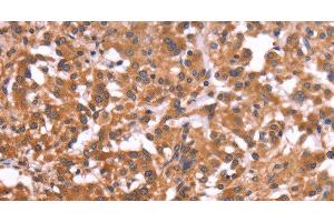Immunohistochemistry of paraffin-embedded Human thyroid cancer tissue using CRISP3 Polyclonal Antibody at dilution 1:50 (CRISP3 anticorps)