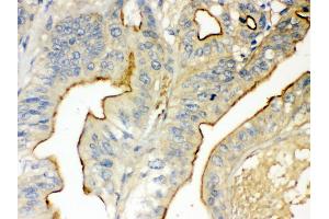Anti- KAT13D/CLOCK antibody, IHC(P) IHC(P): Human Intestinal Cancer Tissue