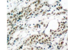 Immunohistochemistry of paraffin-embedded Human breast carcinoma tissue, using Phospho-FOXO4(S197) Polyclonal Antibody