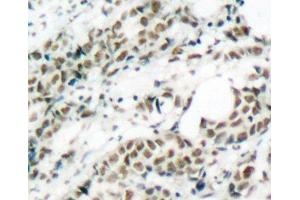 Immunohistochemistry of paraffin-embedded Human breast carcinoma tissue, using Phospho-FOXO4(S197) Polyclonal Antibody (FOXO4 anticorps  (pSer197))