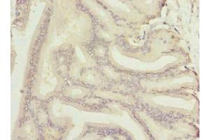 Immunohistochemistry of paraffin-embedded human prostate cancer using ABIN7161983 at dilution of 1:100 (Nucleolar Protein 6 anticorps  (AA 951-1146))