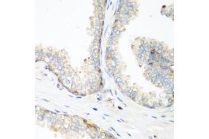 Immunohistochemistry of paraffin-embedded human prostate using NEDD4 antibody (ABIN1681009, ABIN3015207, ABIN3015208 and ABIN6213883) at dilution of 1:200 (40x lens). (NEDD4 anticorps  (AA 160-460))