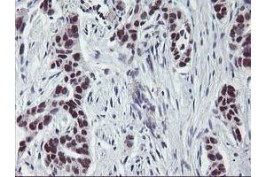 Immunohistochemical staining of paraffin-embedded Carcinoma of Human lung tissue using anti-ANKRD53 mouse monoclonal antibody. (ANKRD53 anticorps  (AA 1-300))