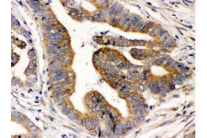 Anti-Rab5 Picoband antibody,IHC(P) IHC(P): Human Intestinal Cancer Tissue (RAB5 anticorps  (C-Term))
