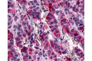 Anti-GPR1 antibody IHC of human Breast, Carcinoma. (G Protein-Coupled Receptor 1 anticorps  (C-Term))