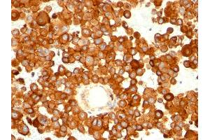 Formalin-fixed, paraffin-embedded human melanoma stained with CD63 Mouse Monoclonal Antibody (MX-49. (CD63 anticorps)