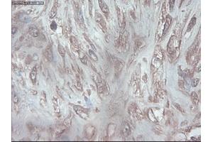 Immunohistochemical staining of paraffin-embedded Carcinoma of pancreas using anti-PDX1 (ABIN2452675) mouse monoclonal antibody. (PDX1 anticorps)