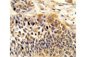 IHC analysis of FFPE human bladder carcinoma stained with WNT4 antibody (WNT4 anticorps  (AA 211-239))