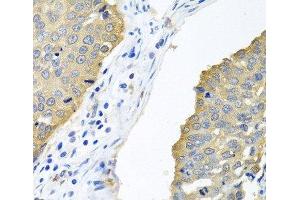 Immunohistochemistry of paraffin-embedded Human lung cancer using EIF4E Polyclonal Antibody at dilution of 1:100 (40x lens). (EIF4E anticorps)