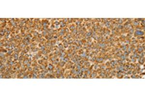 Immunohistochemistry of paraffin-embedded Human liver cancer tissue using VDAC2 Polyclonal Antibody at dilution of 1:25(x200) (VDAC2 anticorps)