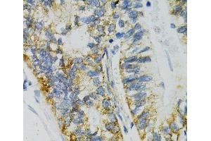 Immunohistochemistry of paraffin-embedded Human gastric cancer using SLC27A2 Polyclonal Antibody at dilution of 1:100 (40x lens).