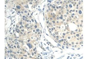 Detection of CALML3 in Human Prostate cancer Tissue using Polyclonal Antibody to Calmodulin Like Protein 3 (CALML3) (CALML3 anticorps  (AA 1-149))