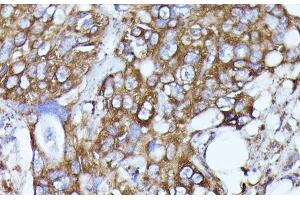 Immunohistochemistry of paraffin-embedded Human colon carcinoma using N-WASP Polyclonal Antibody at dilution of 1:100 (40x lens). (Neural Wiskott-Aldrich syndrome protein (WASL) anticorps)