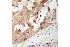 Immunohistochemical analysis of PAK1 staining in human prostate cancer formalin fixed paraffin embedded tissue section. (PAK1 anticorps)