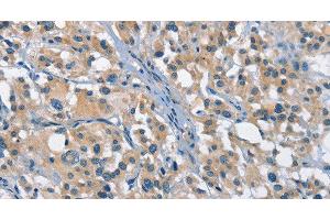 Immunohistochemistry of paraffin-embedded Human thyroid cancer tissue using GAS2 Polyclonal Antibody at dilution 1:50