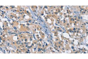 Immunohistochemistry of paraffin-embedded Human thyroid cancer tissue using GAS2 Polyclonal Antibody at dilution 1:50 (GAS2 anticorps)