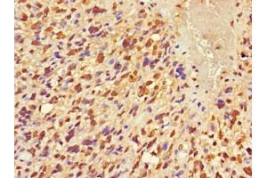 Immunohistochemistry of paraffin-embedded human glioma using ABIN7152681 at dilution of 1:100 (FRMD5 anticorps  (AA 295-504))