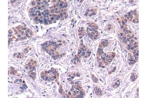 Detection of C4 in Human Liver cancer Tissue using Polyclonal Antibody to Complement Component 4 (C4)
