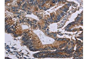 The image on the left is immunohistochemistry of paraffin-embedded Human colon cancer tissue using ABIN7128956(CLDND1 Antibody) at dilution 1/50, on the right is treated with fusion protein. (CLDND1 anticorps)
