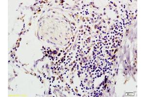 Formalin-fixed and paraffin embedded human colon carcinoma tissue with Anti-IFABP Polyclonal Antibody, Unconjugated  at 1:200, followed by conjugation to the secondary antibody and DAB staining